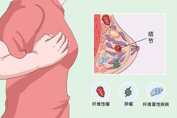 乳腺增生的自我检查方法
